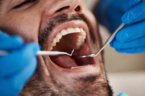 Best Knocked-Out Tooth (Avulsed Tooth) Treatment in Bell Gardens, CA